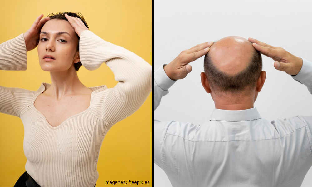 Miedo a quedarse calvos - Diferentes tipos de alopecia